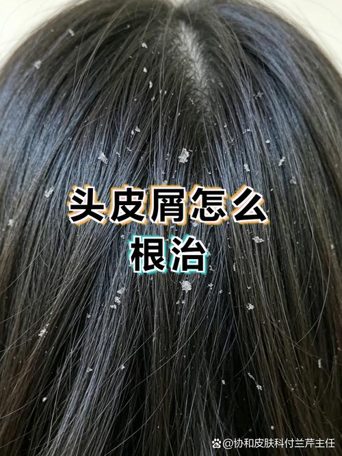頭皮屑根治需先明確類型,再針對性調整護理習慣與